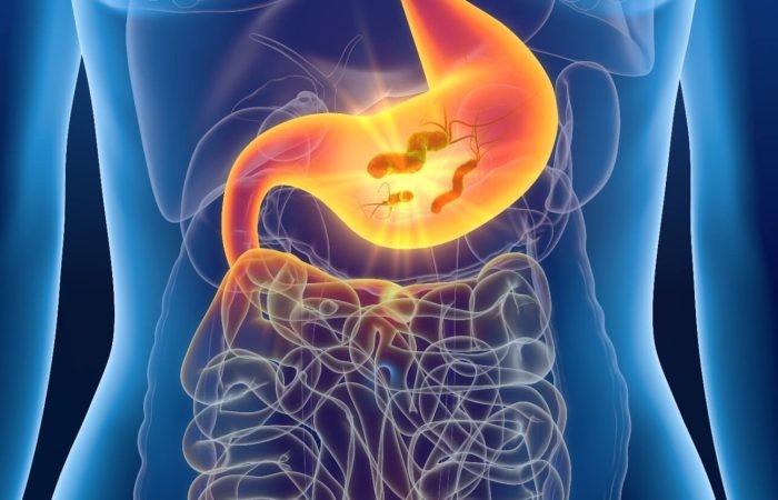 Helicobacter pylori e apparato gastrointestinale