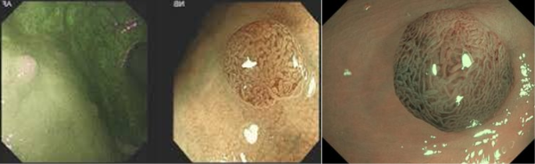 Immagini endoscopiche di polipi del colon