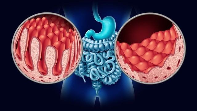 Schema dei villi intestinali nella malattia celiaca